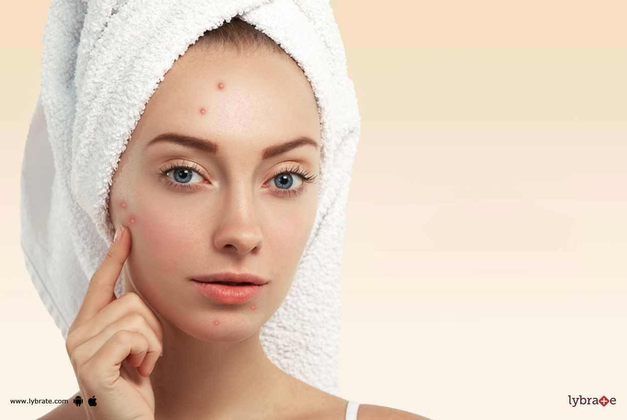 Acne - Know Reasons Behind It!