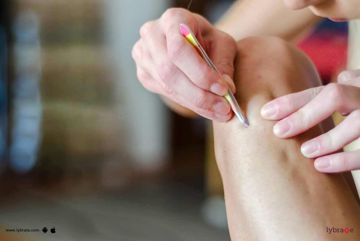 Ingrown Hair - All You Need To Know