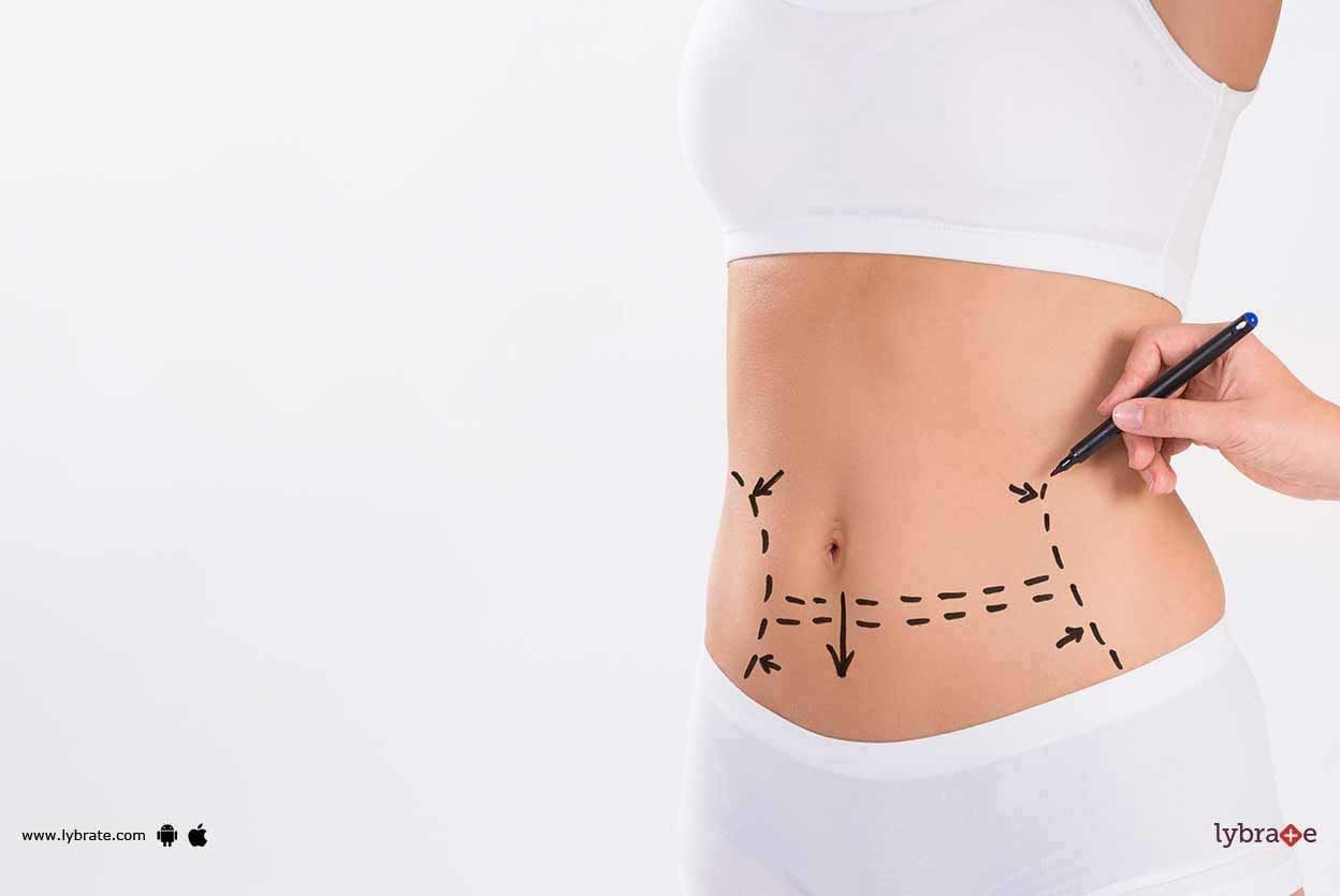 Tummy Tuck Surgery - Know Types Of It!