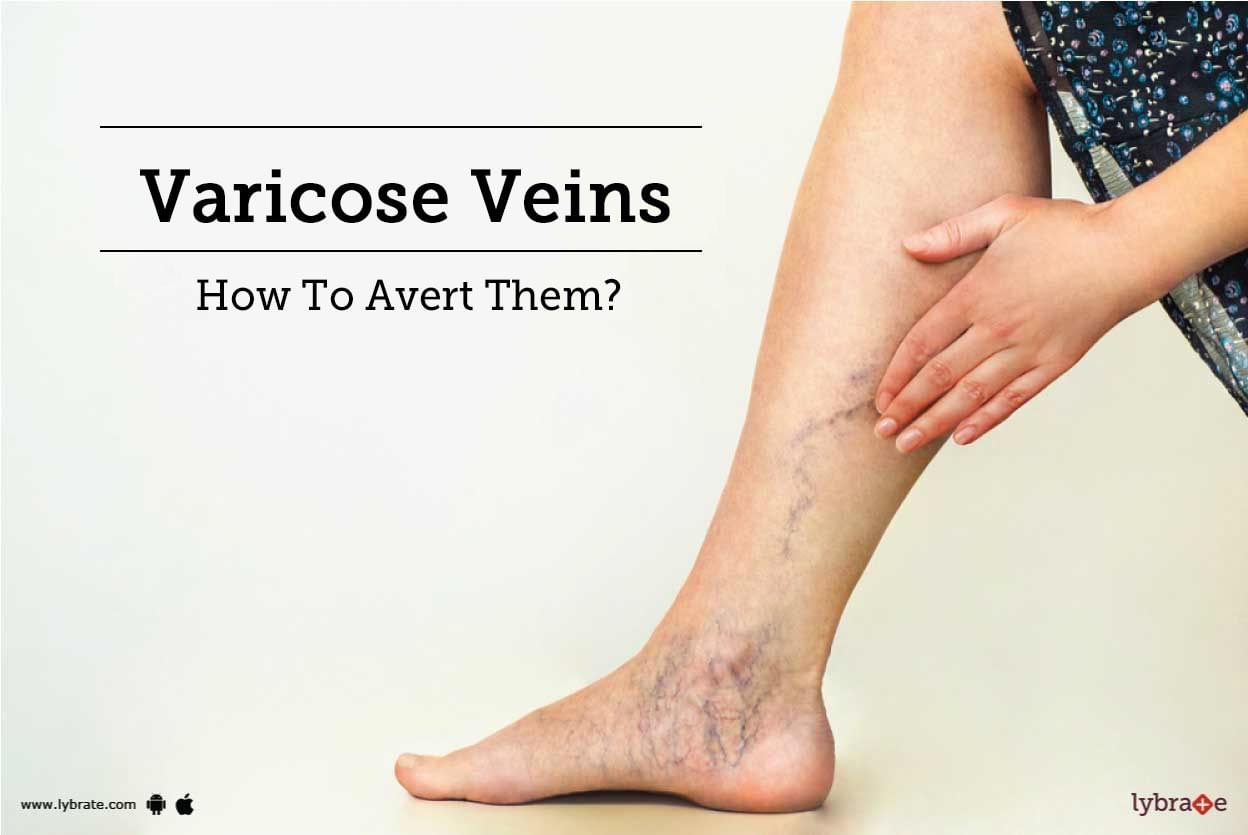 Varicose Veins - How To Avert Them?