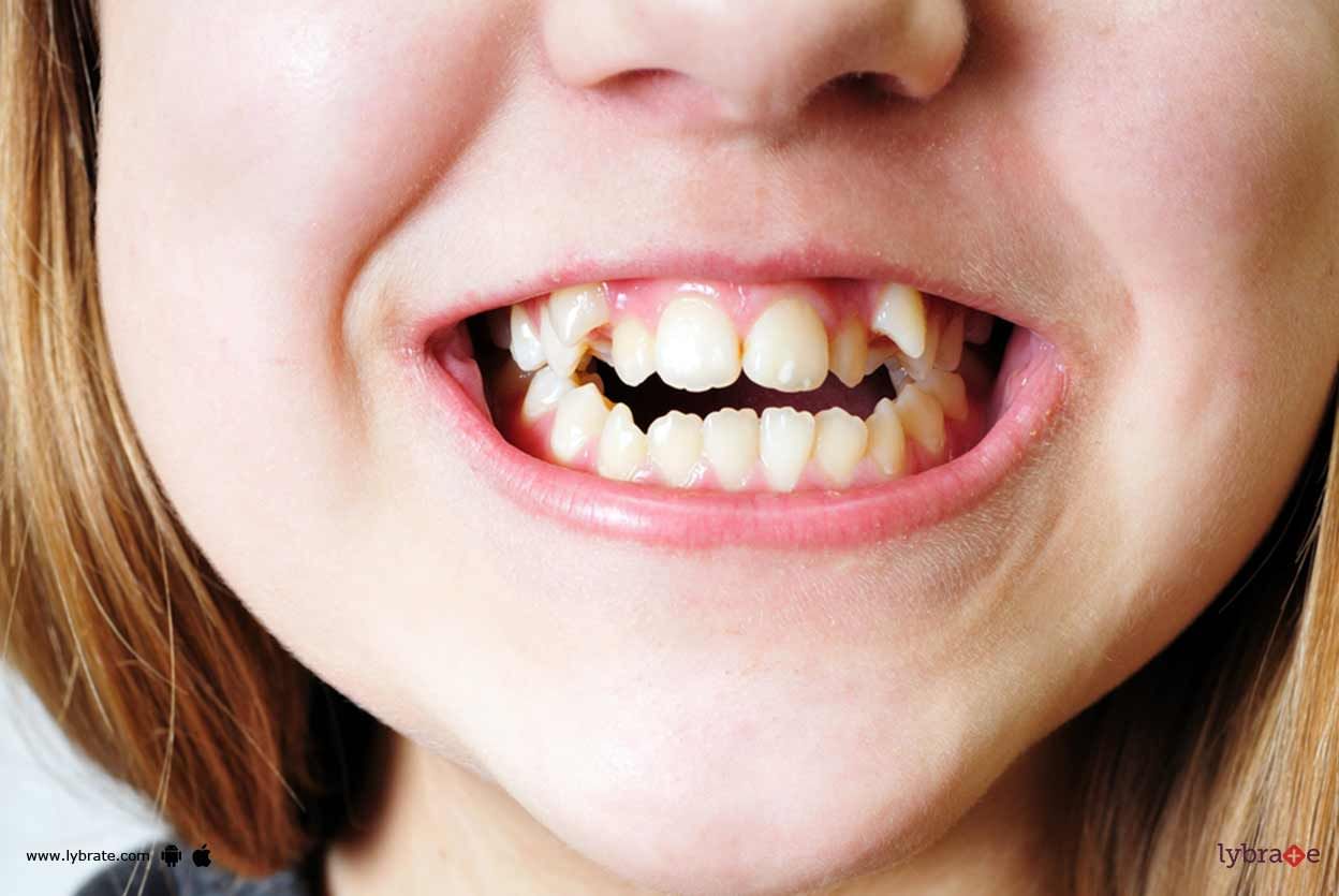 Chipped Tooth - How Can You Administer It?
