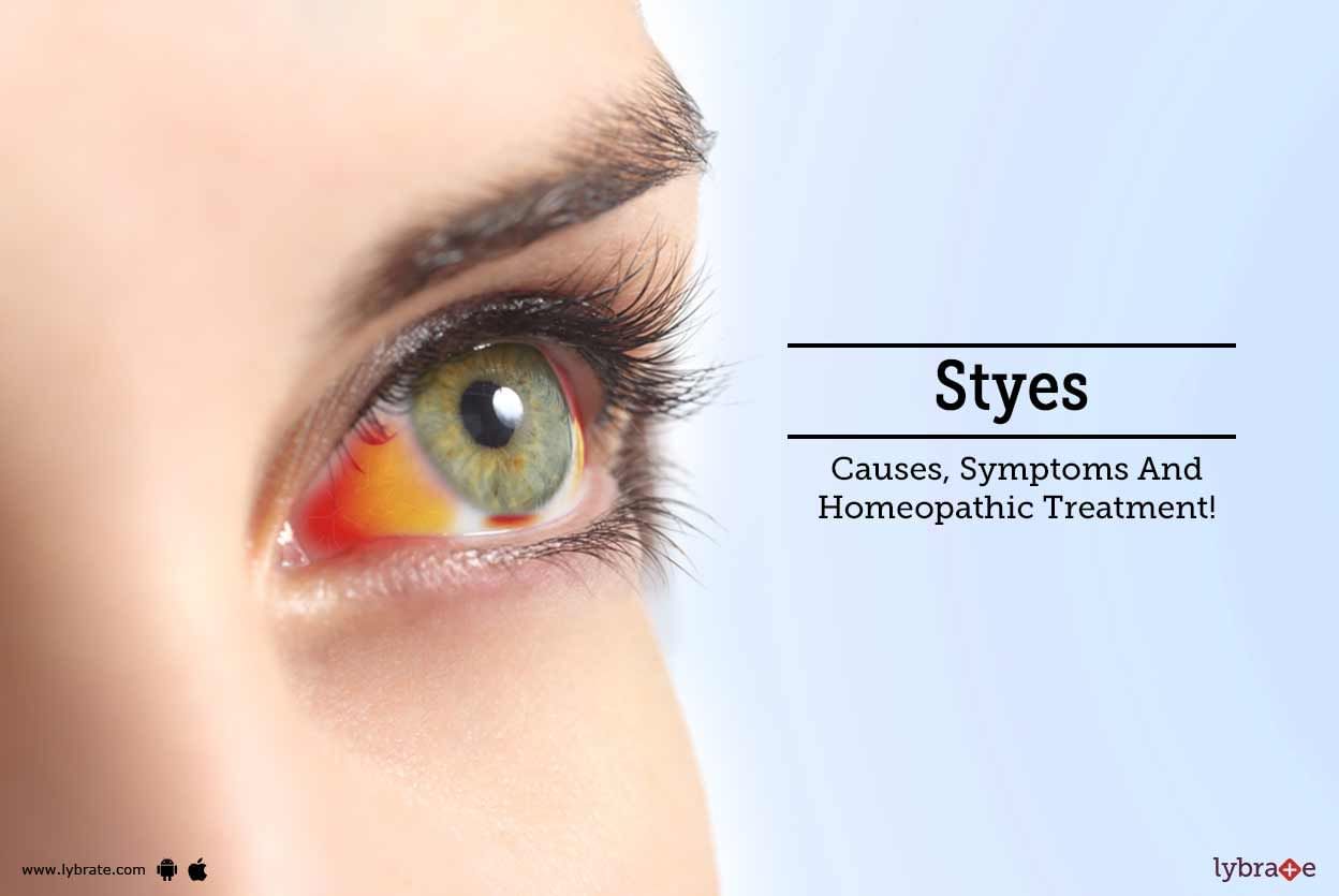 Styes - Causes, Symptoms And Homeopathic Treatment!