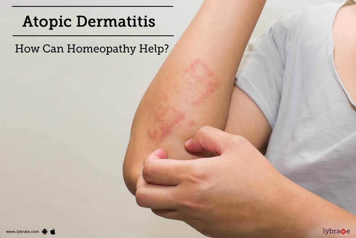 Atopic Dermatitis - How Can Homeopathy Help?