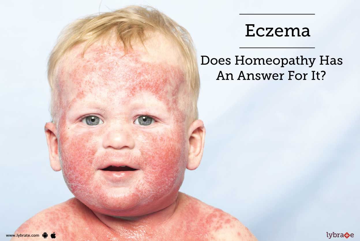 Eczema - Does Homeopathy Has An Answer For It?