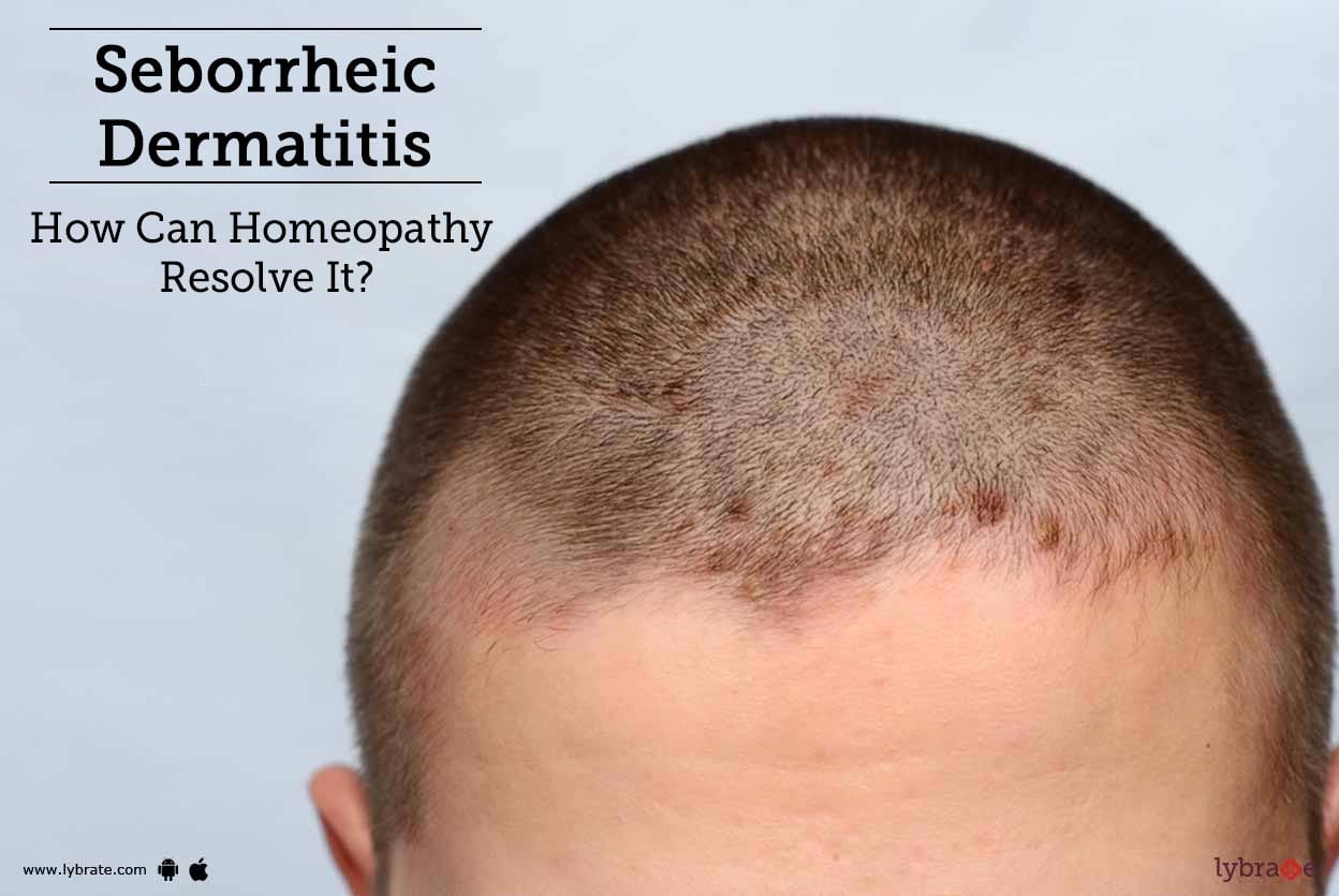 Seborrheic Dermatitis - How Can Homeopathy Resolve It?