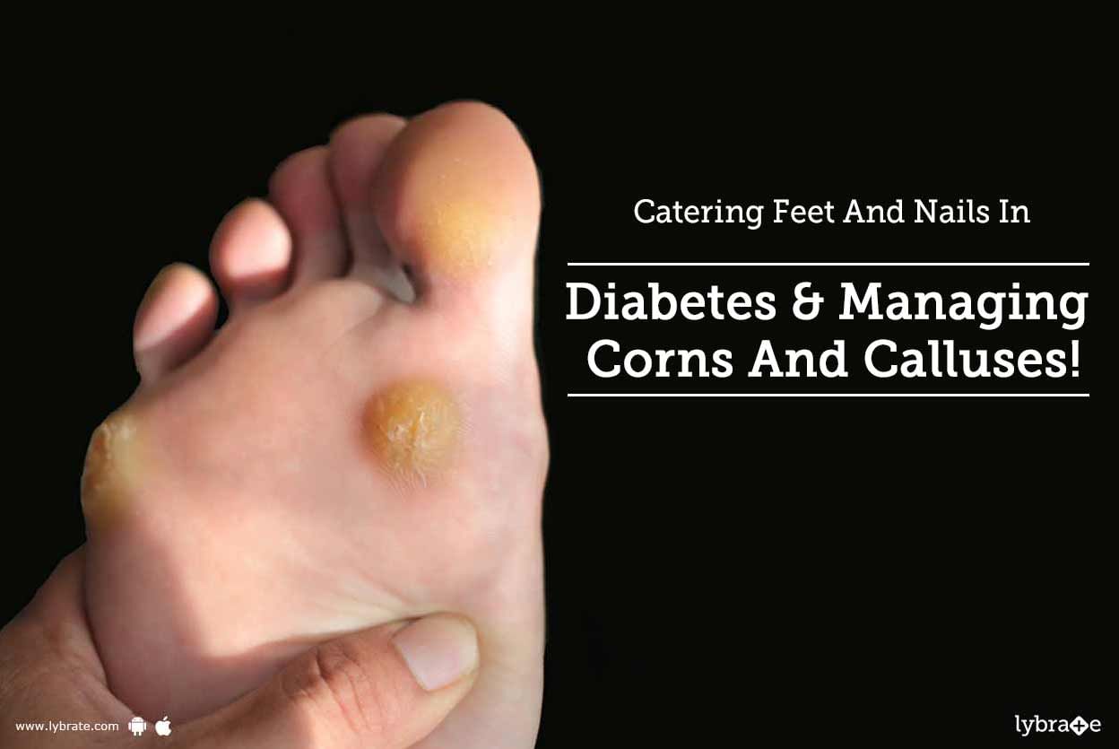 Catering Feet And Nails In Diabetes & Managing Corns And Calluses!
