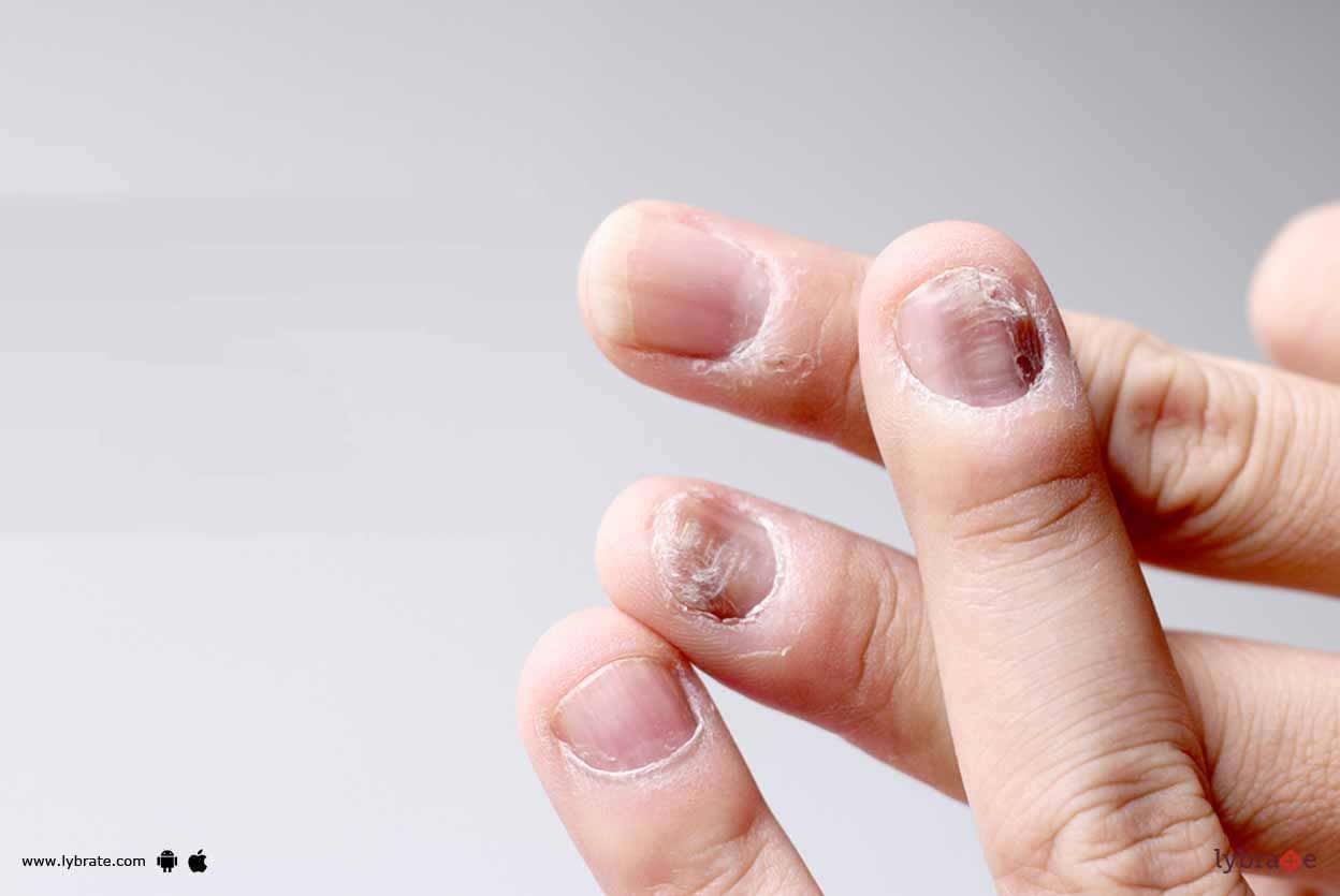 Fungal Nail Infection - Signs & Causes Of It!