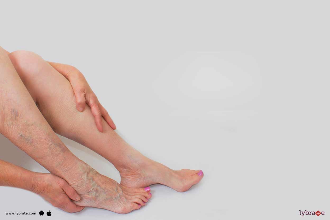 Varicose Veins - How To Identify It?