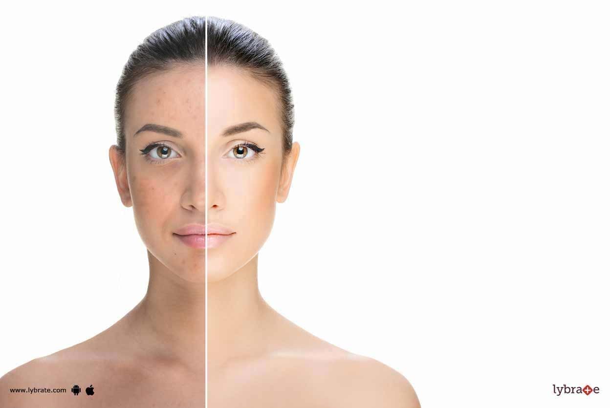5 Causes Of Melasma And Its Treatment!