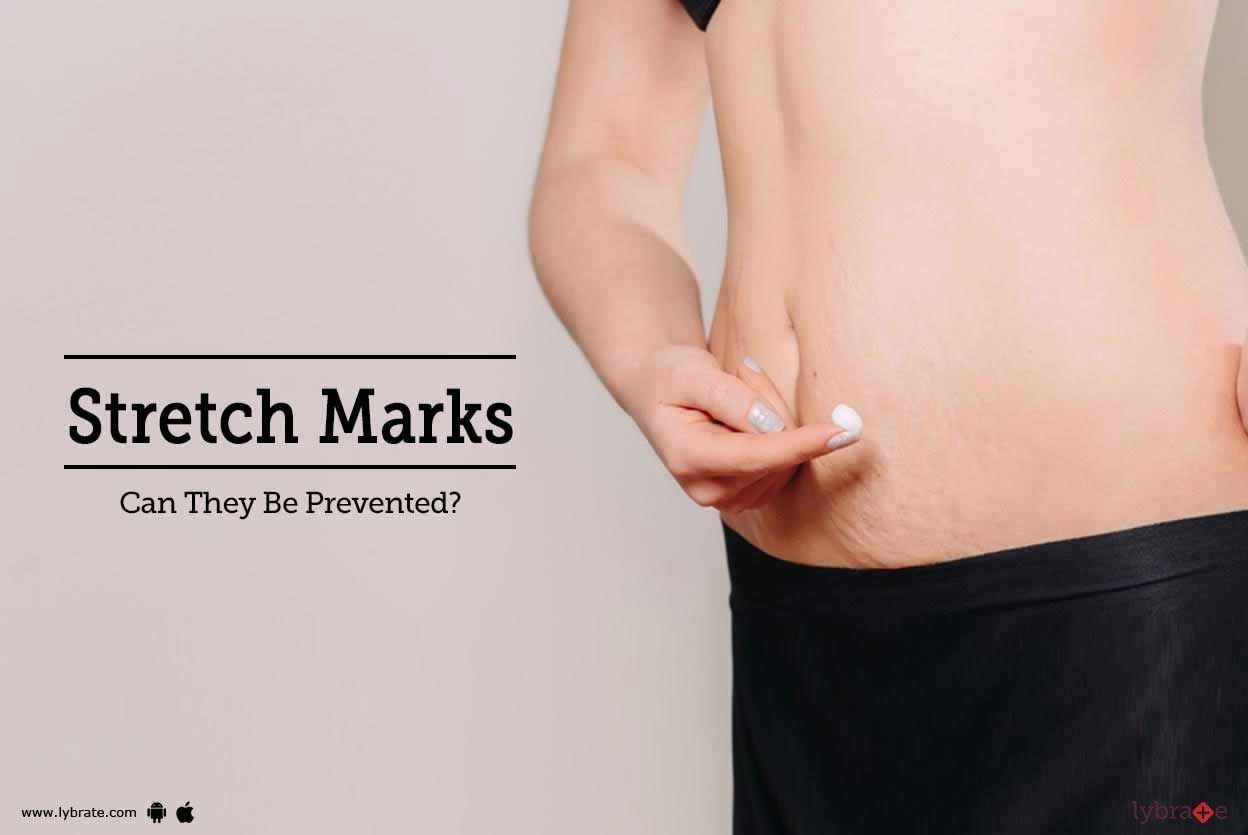 Stretch Marks - Can They Be Prevented?