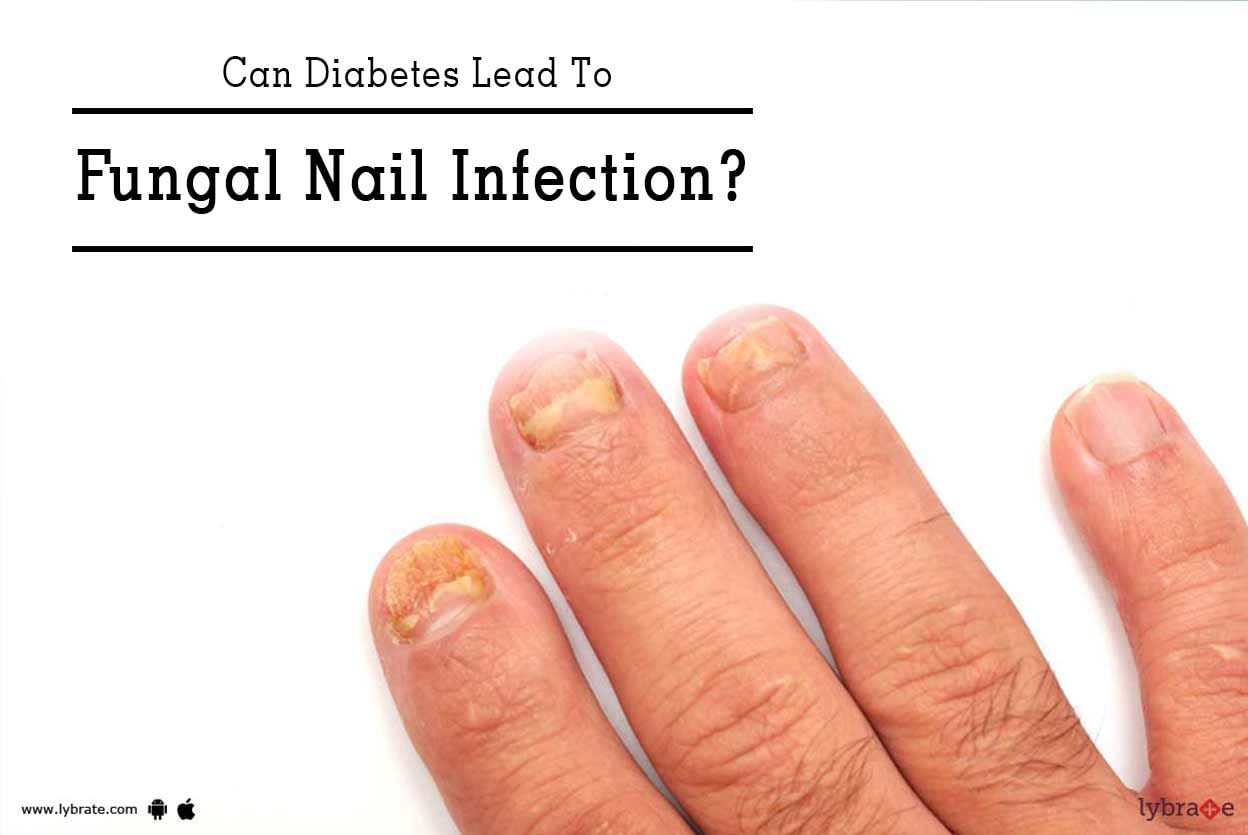 Can Diabetes Lead To Fungal Nail Infection?