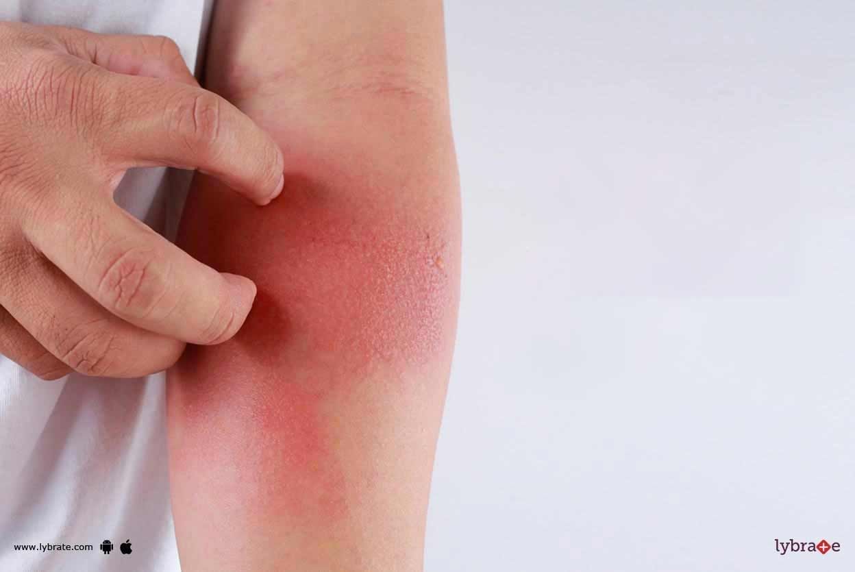 Allergic Eczema - How To Resolve It?