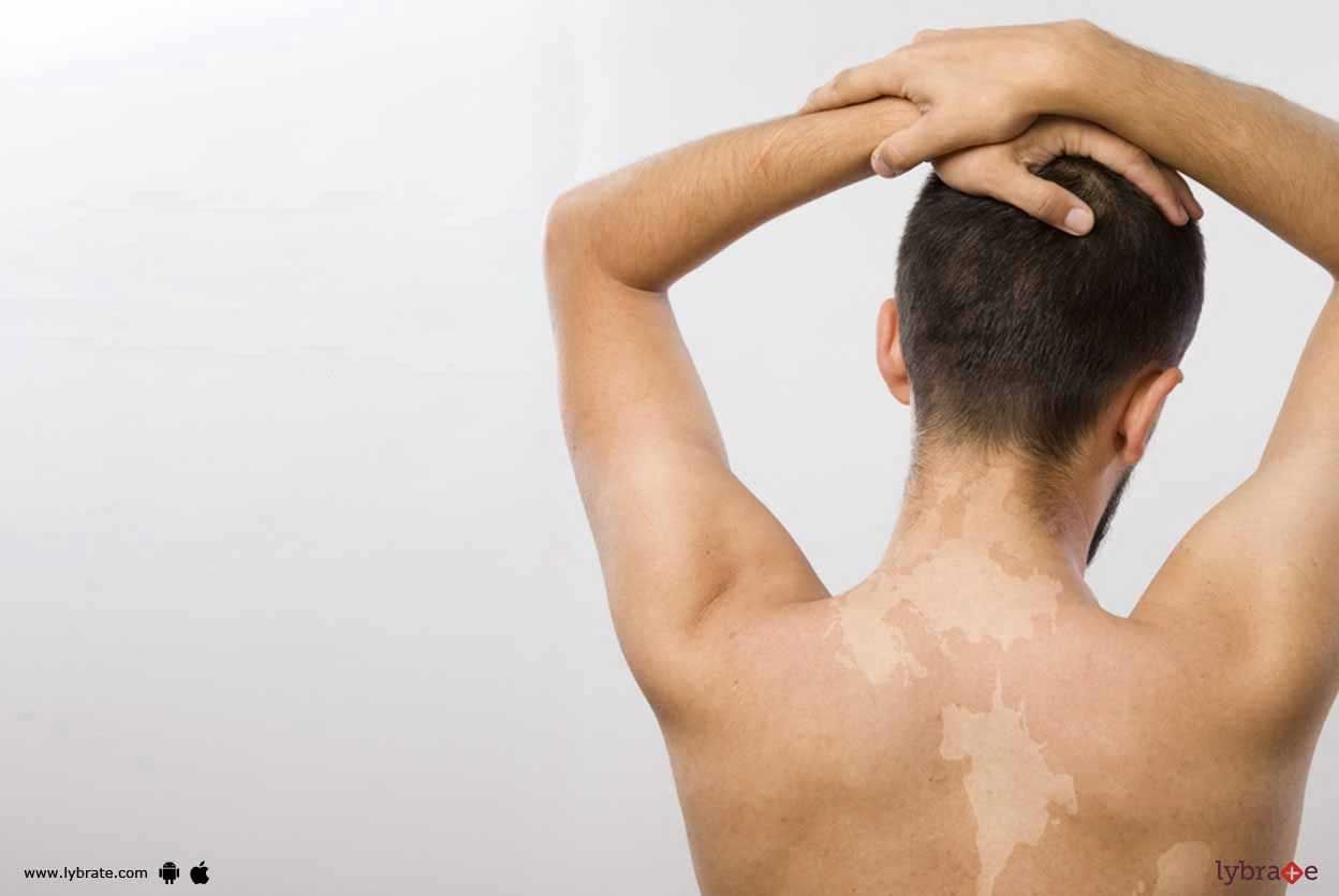 Drug Induced Skin Pigmentation - What Should You Know?