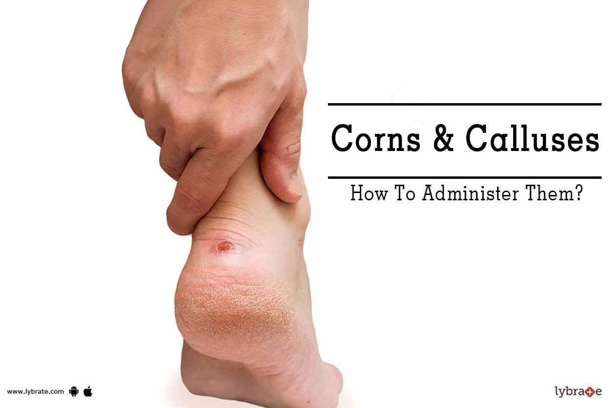 Corns & Calluses - How To Administer Them?