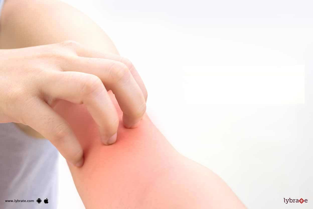 Eczema - How Can Homeopathy Resolve It?
