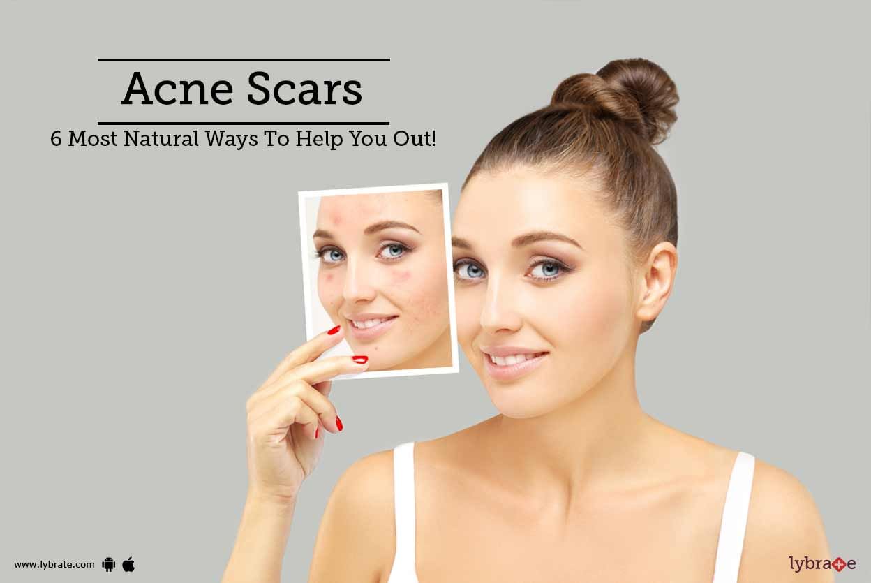 Acne Scars - 6 Most Natural Ways To Help You Out!