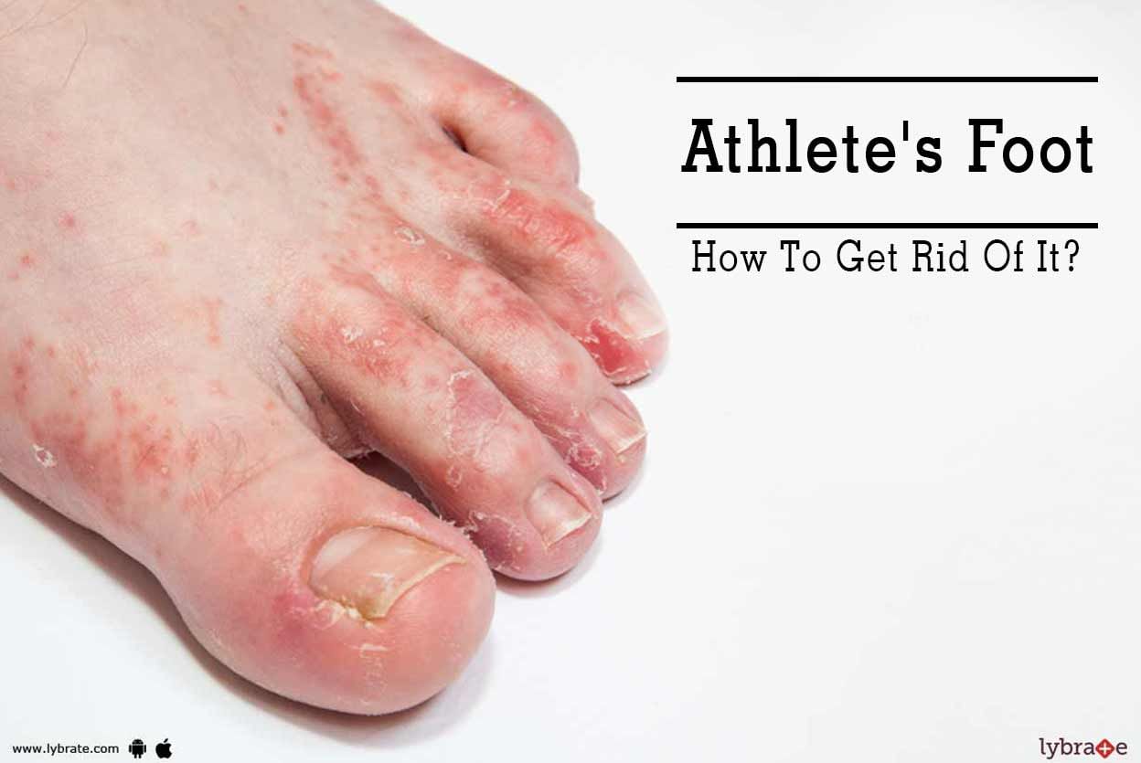 Athlete's Foot - How To Get Rid Of It?