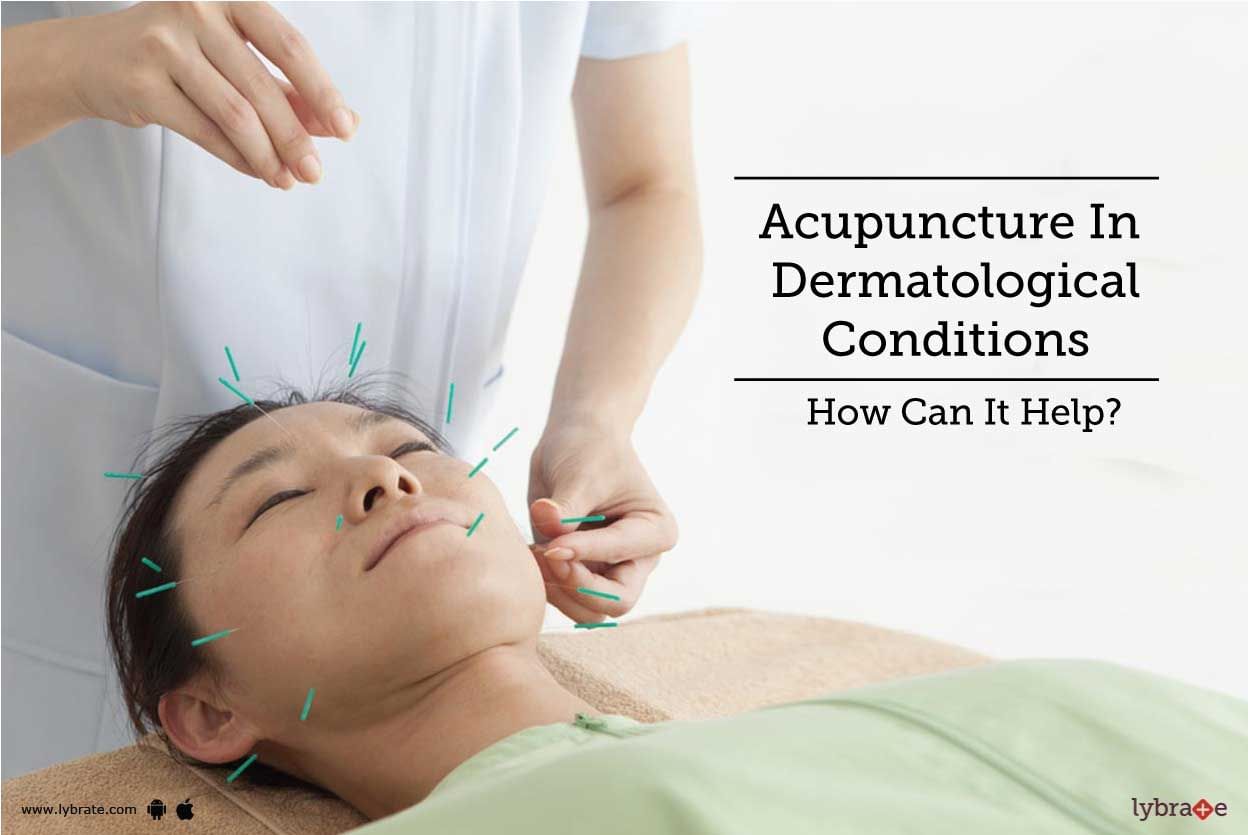 Acupuncture In Dermatological Conditions - How Can It Help?