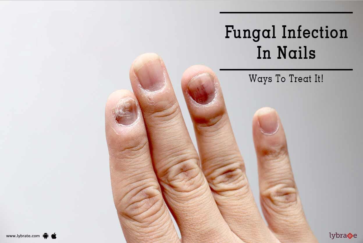 Fungal Infection In Nails - Ways To Treat It!