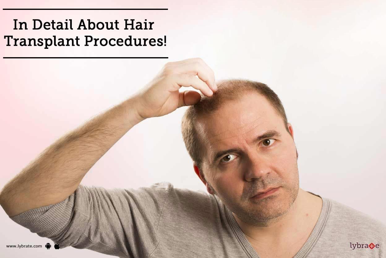 In Detail About Hair Transplant Procedures!