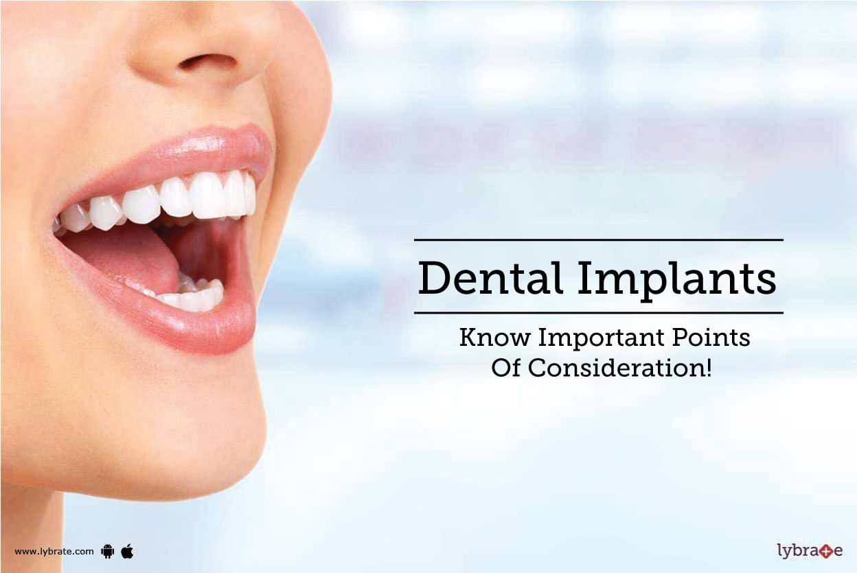 Dental Implants - Know Important Points Of Consideration!