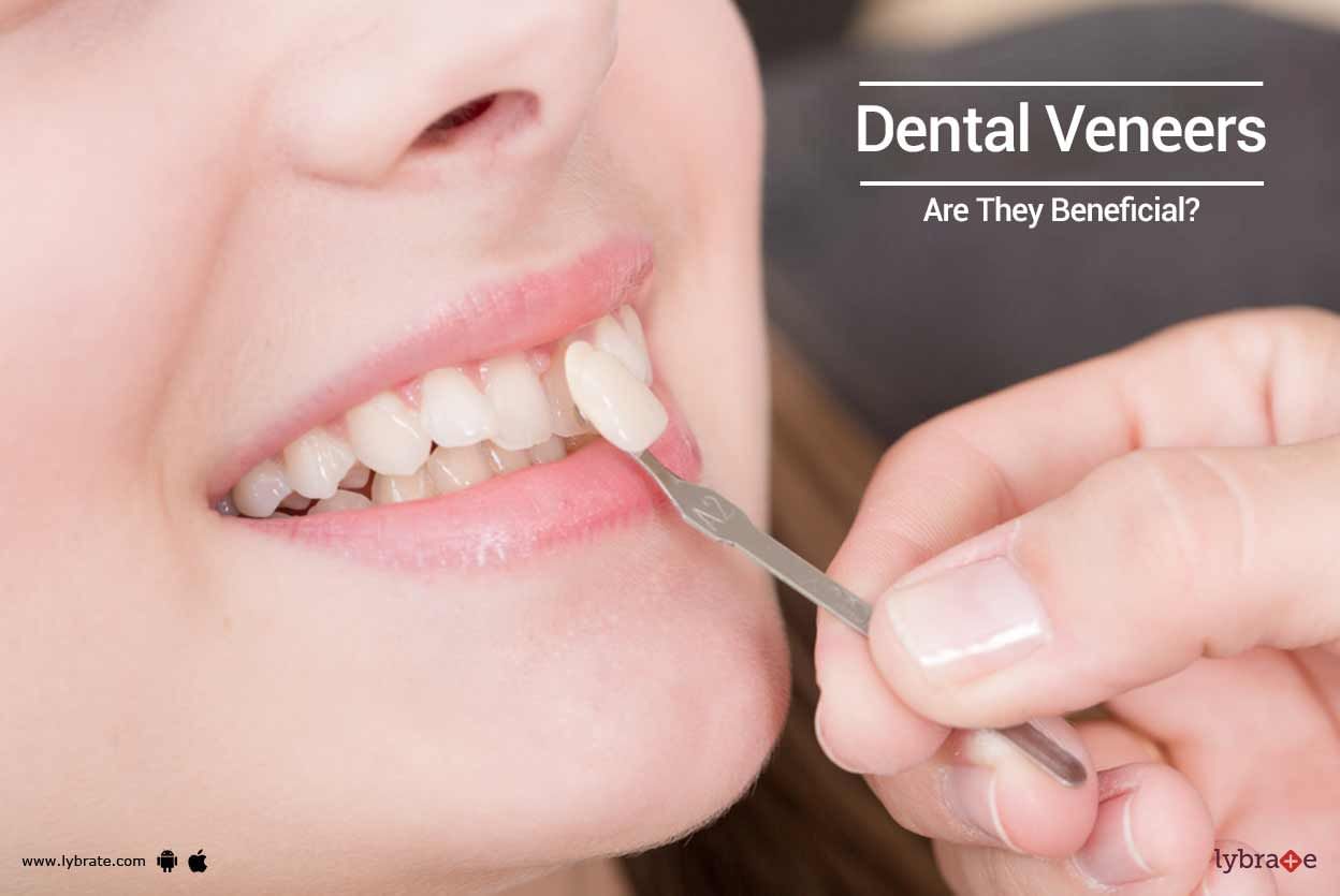 Dental Veneers - Are They Beneficial?
