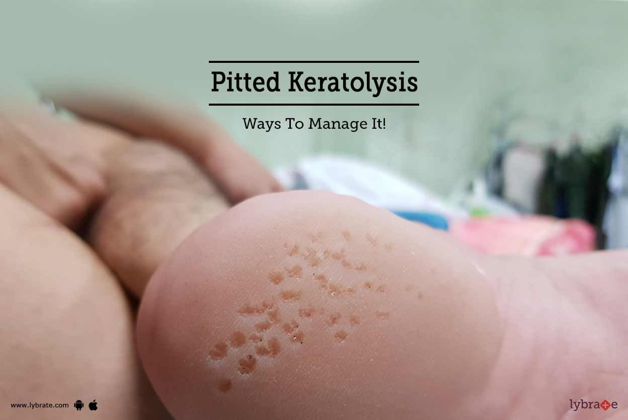 Pitted Keratolysis - Ways To Manage It!
