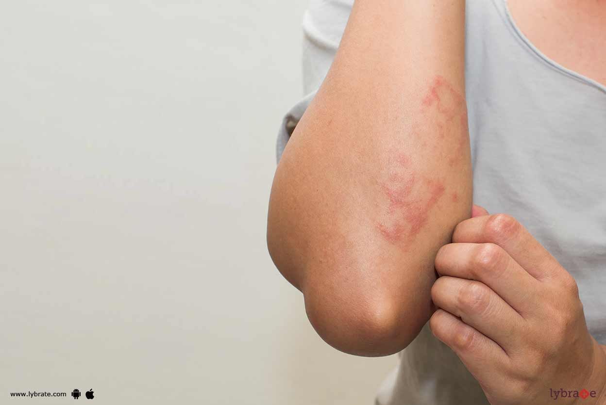 Protein Contact Dermatitis - How To Administer It?