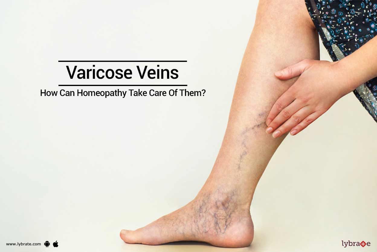 Varicose Veins - How Can Homeopathy Take Care Of Them?