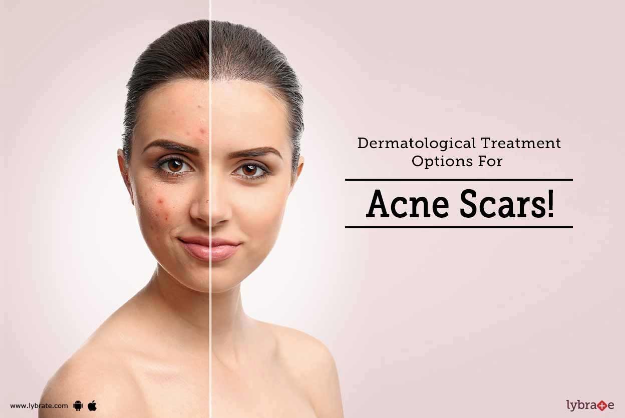 Dermatological Treatment Options For Acne Scars!