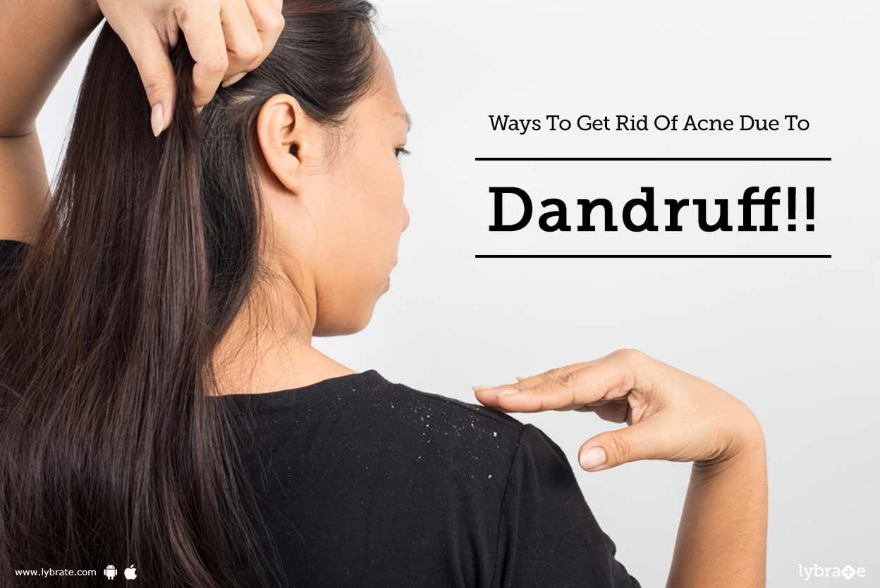 Ways To Get Rid Of Acne Due To Dandruff!!