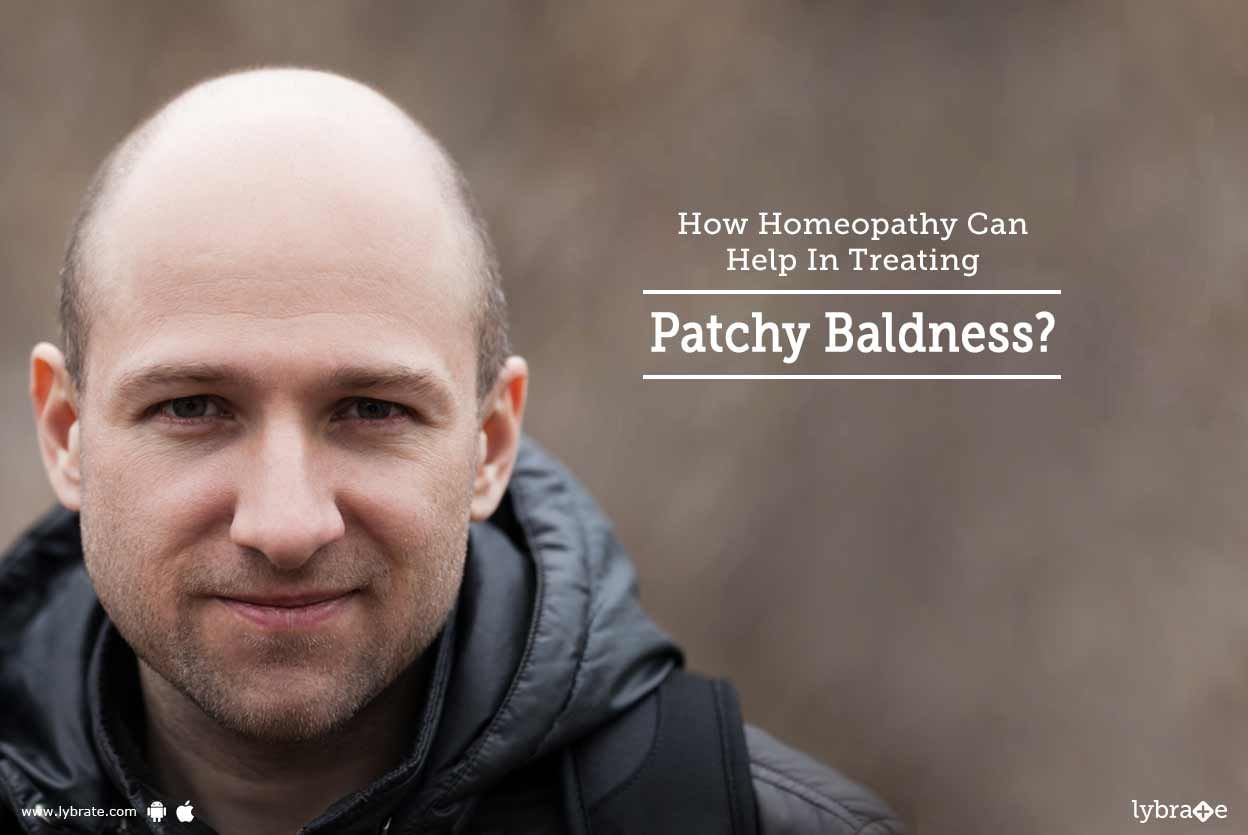 How Homeopathy Can Help In Treating Patchy Baldness?