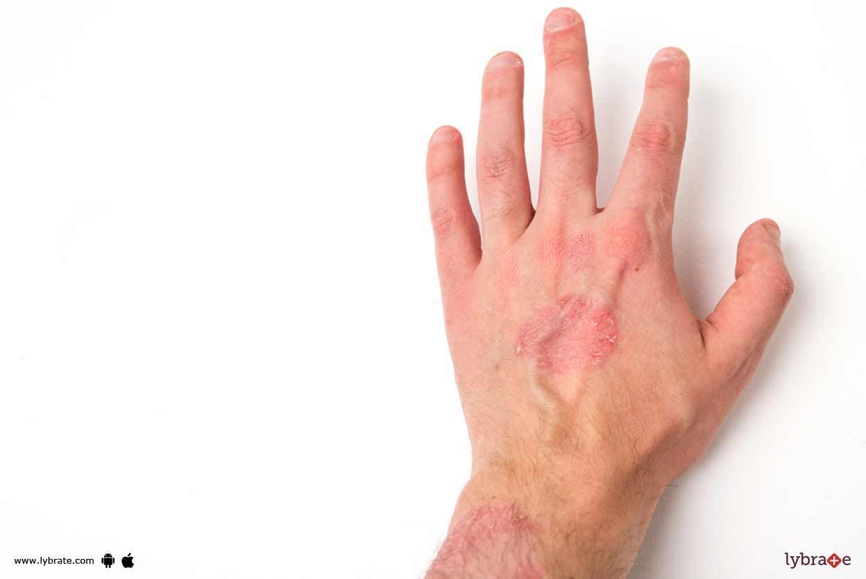 Psoriasis - Have Homeopathy To Handle It!