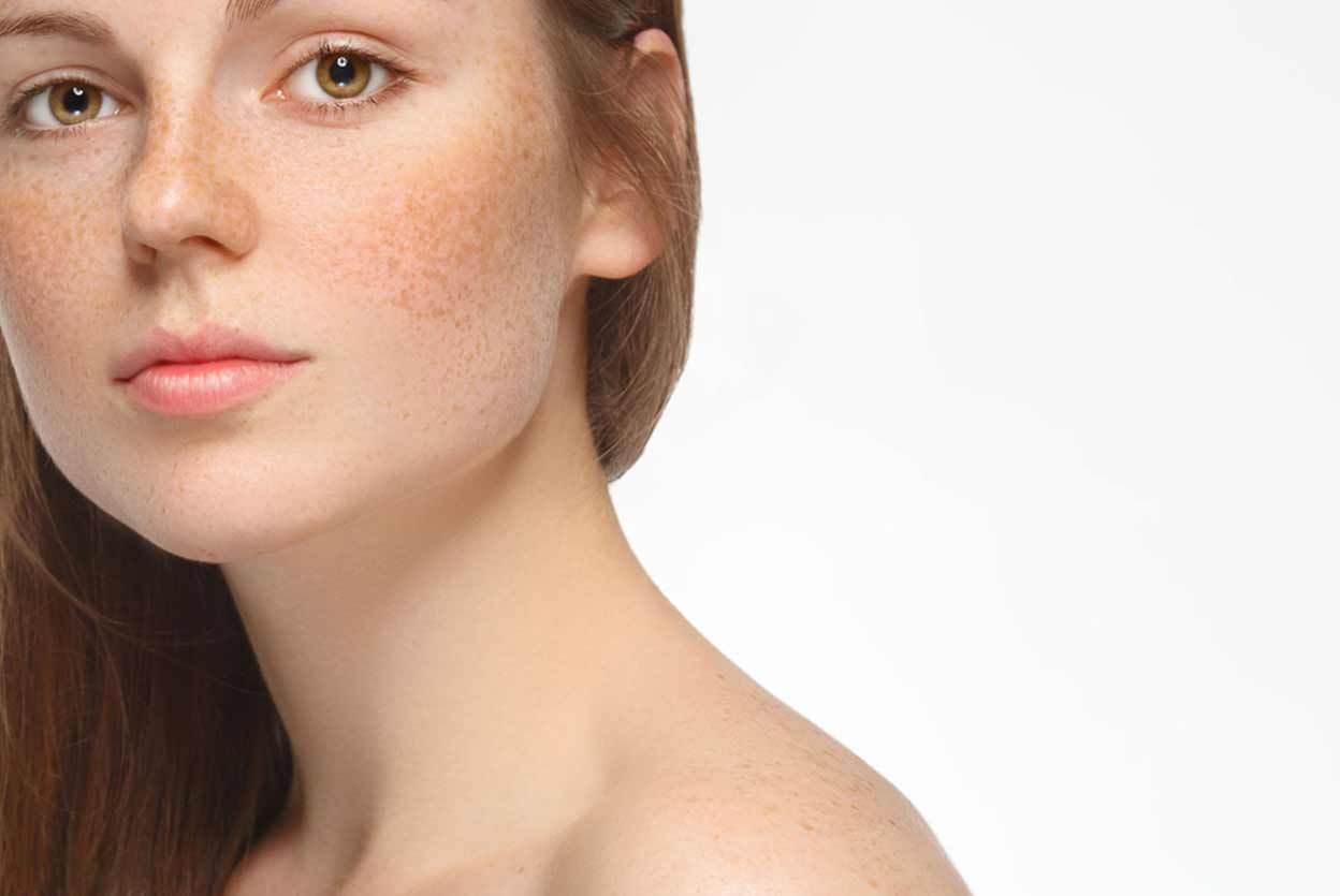 How to Get Rid of Hyperpigmentation?
