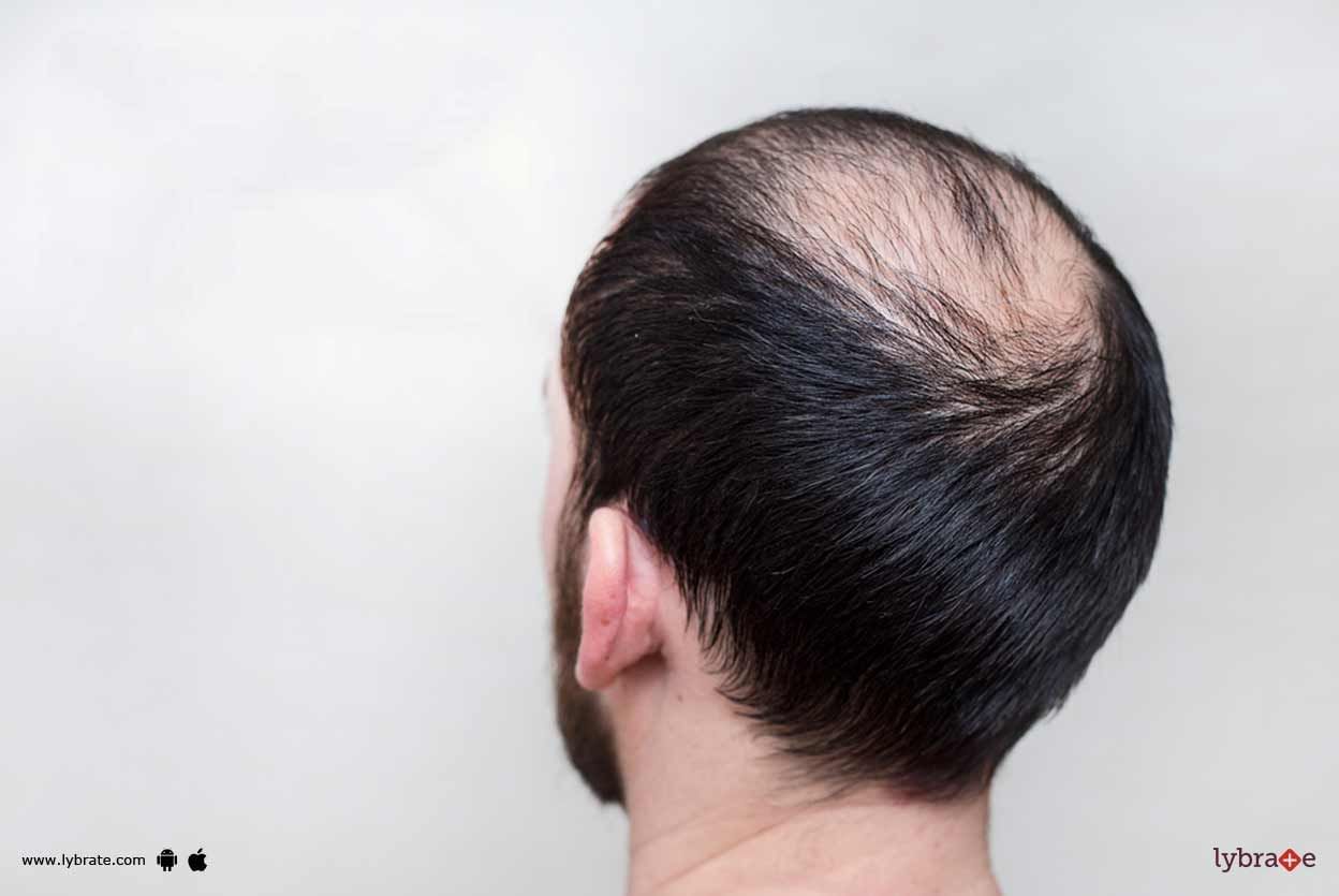 Baldness - Know The Ayurvedic Treatment For It!