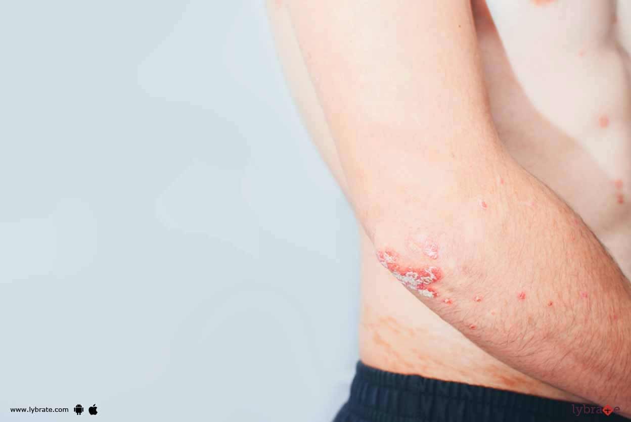Psoriasis - Can Homeopathy Handle It?
