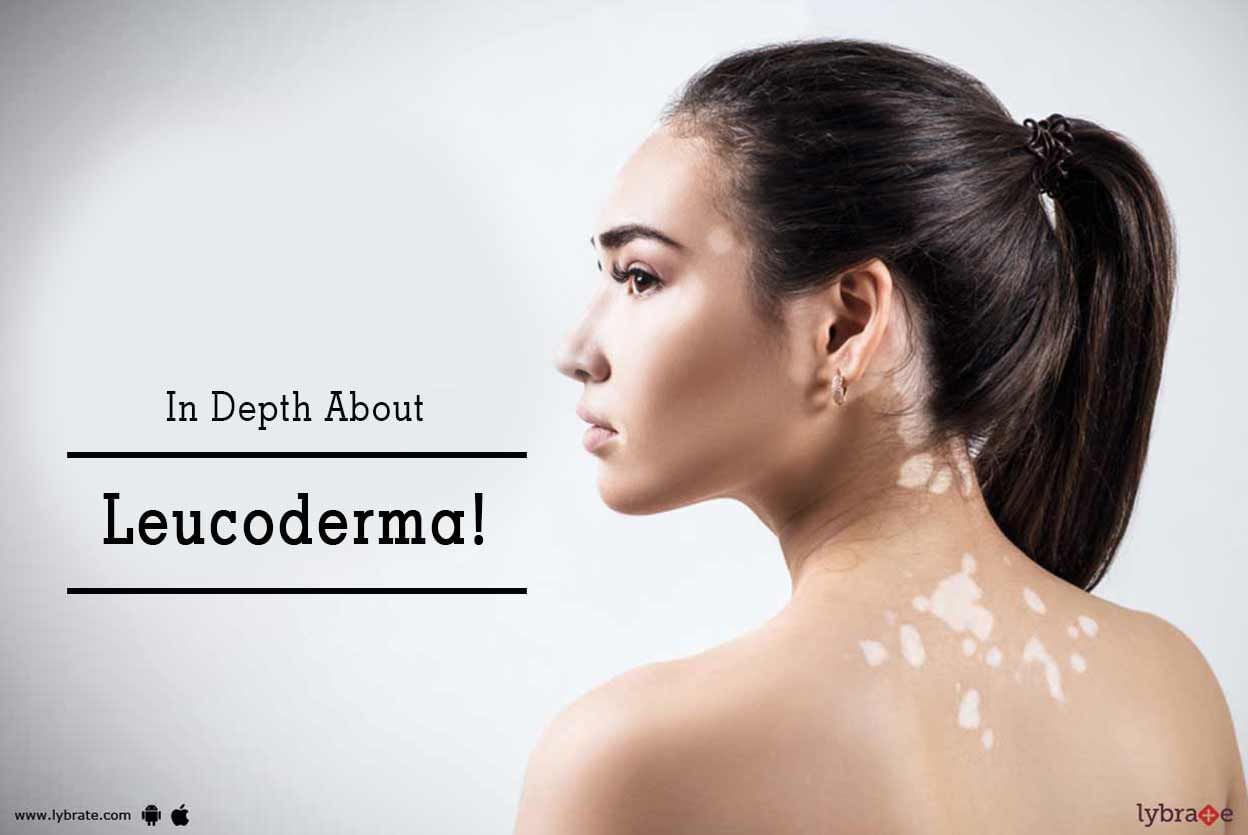 In Depth About Leucoderma!