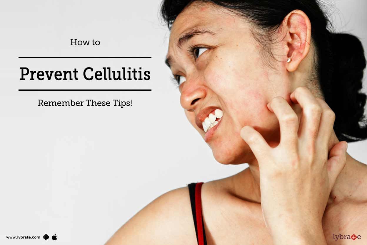 How to Prevent Cellulitis: Remember These Tips!