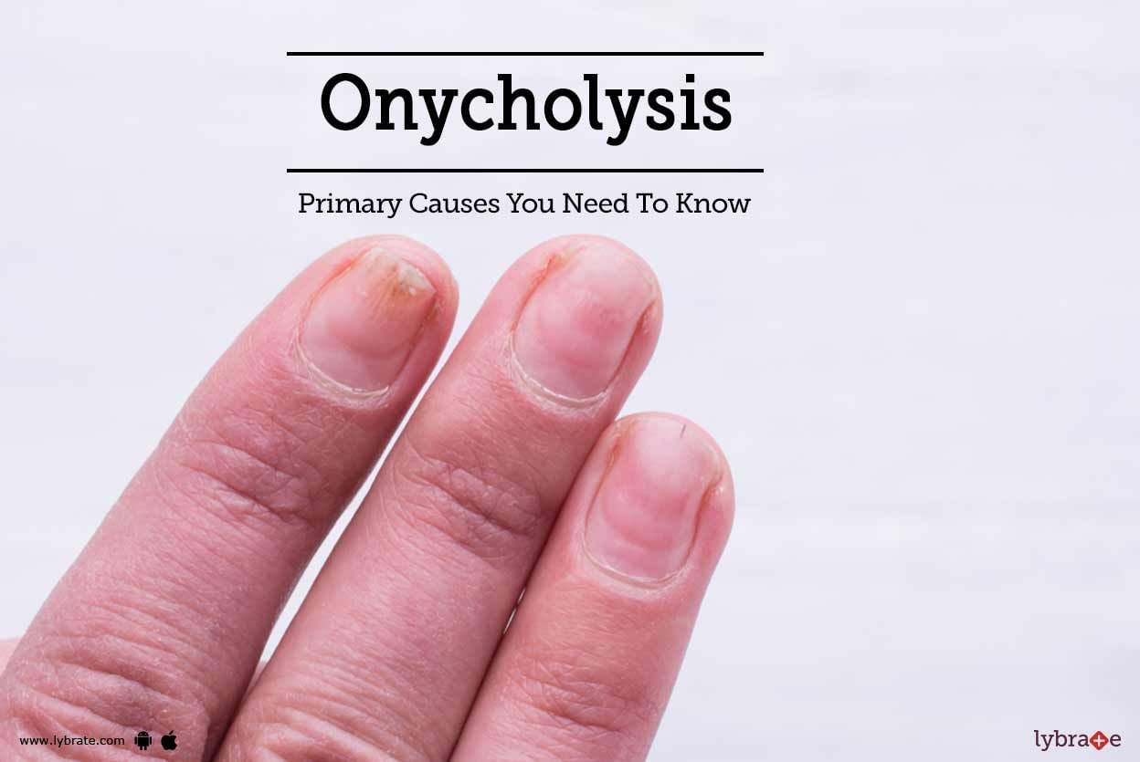 Onycholysis: Primary Causes You Need To Know! - By Dr. Mohna | Lybrate