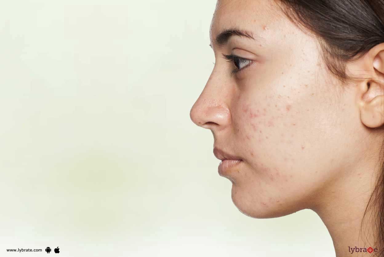 Rosacea - How To Handle It?