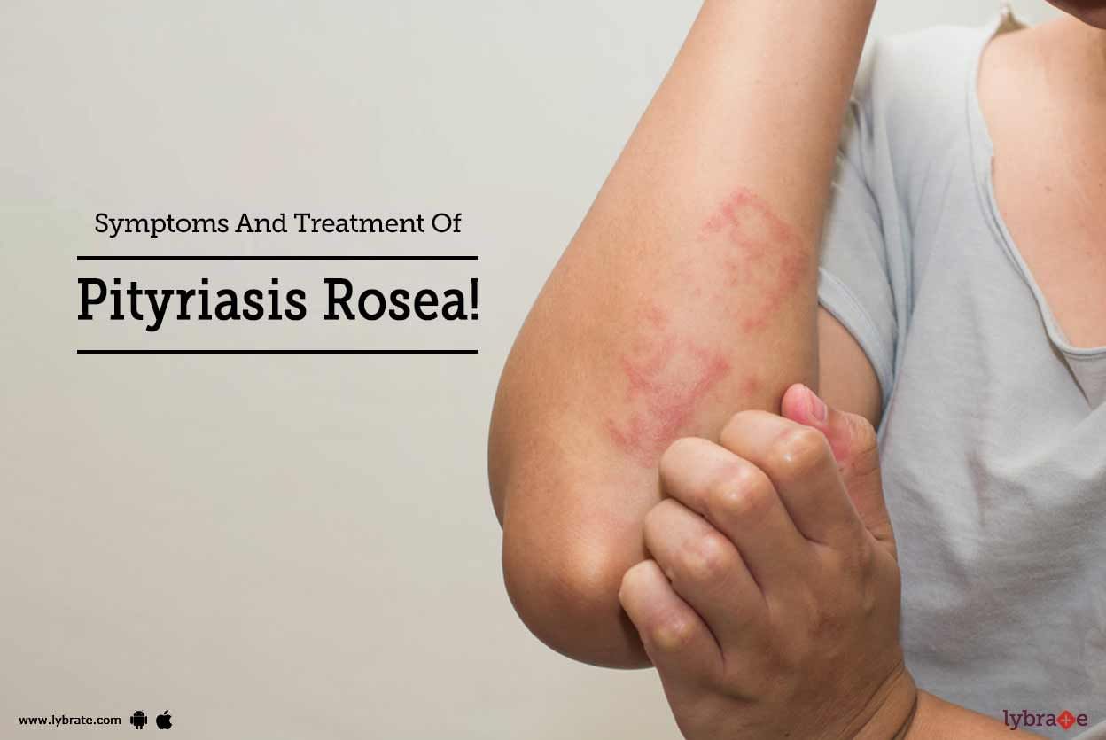 Symptoms And Treatment Of Pityriasis Rosea!