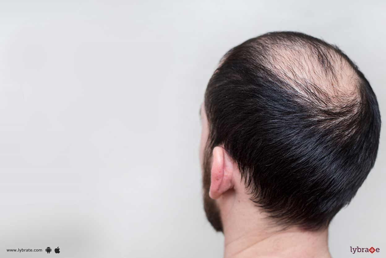 Alopecia Areata - How To Tackle It?
