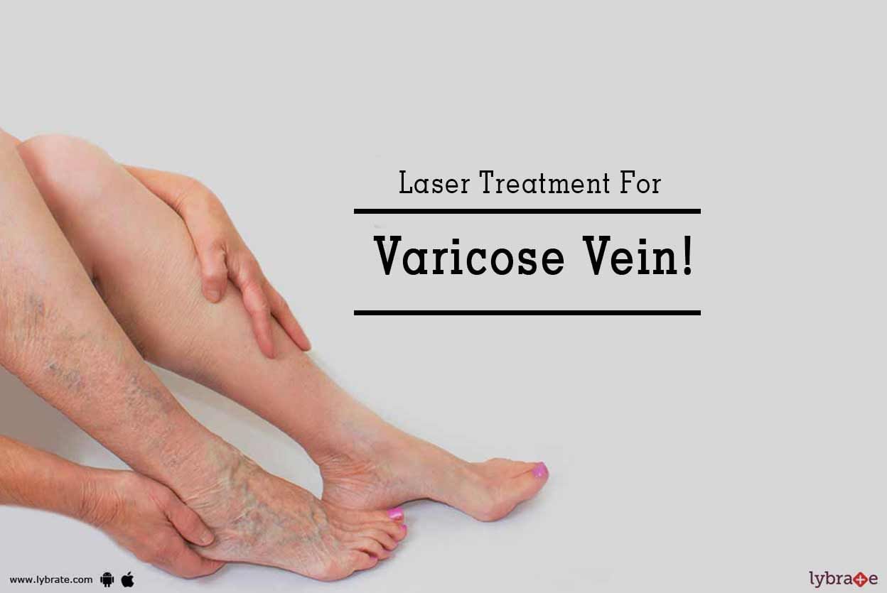 Laser Treatment For Varicose Vein!
