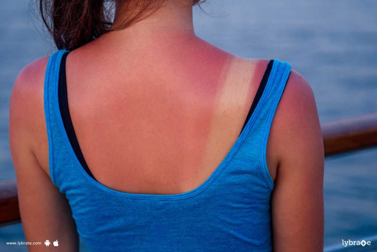 Sunburn - How To Administer It?