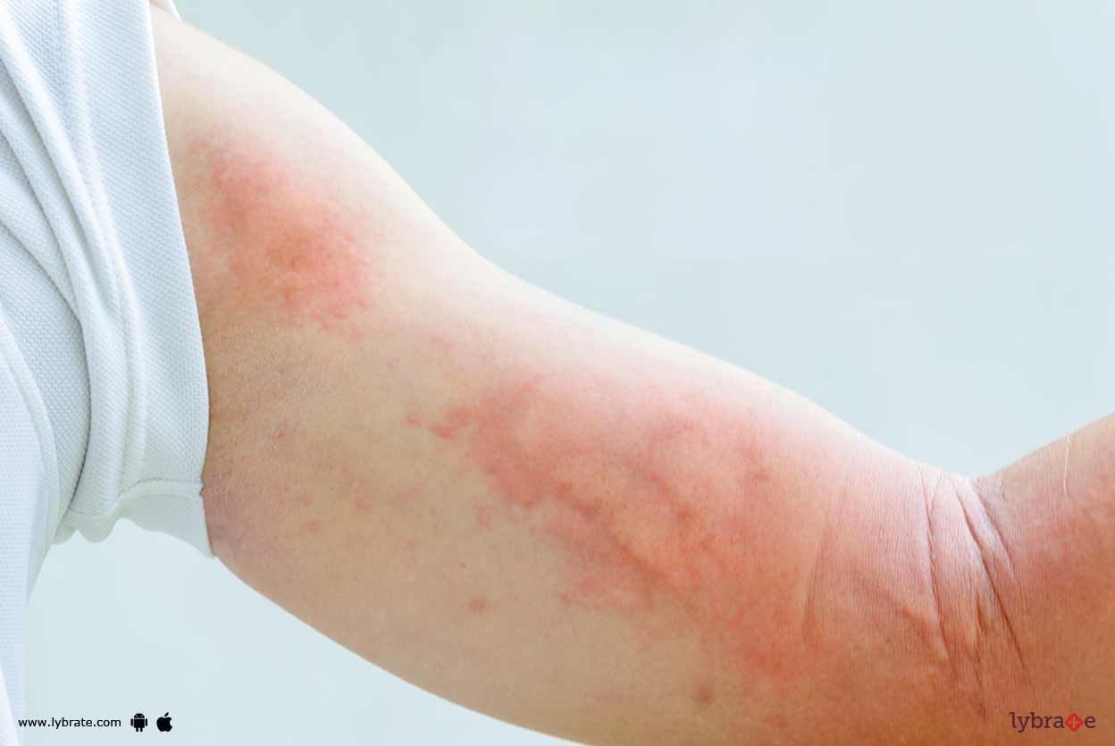 Cutaneous Leishmaniasis - How To Get Rid Of It?