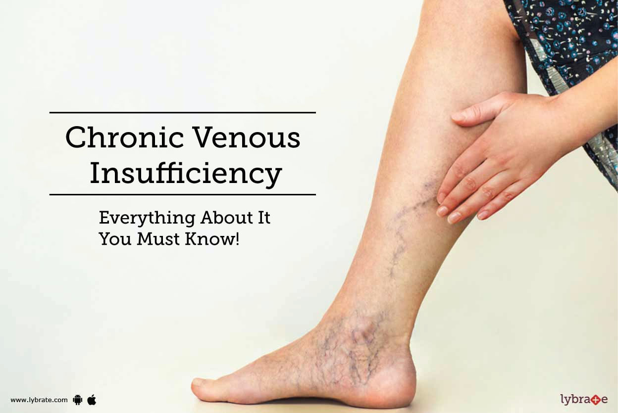Chronic Venous Insufficiency - Everything About It You Must Know!