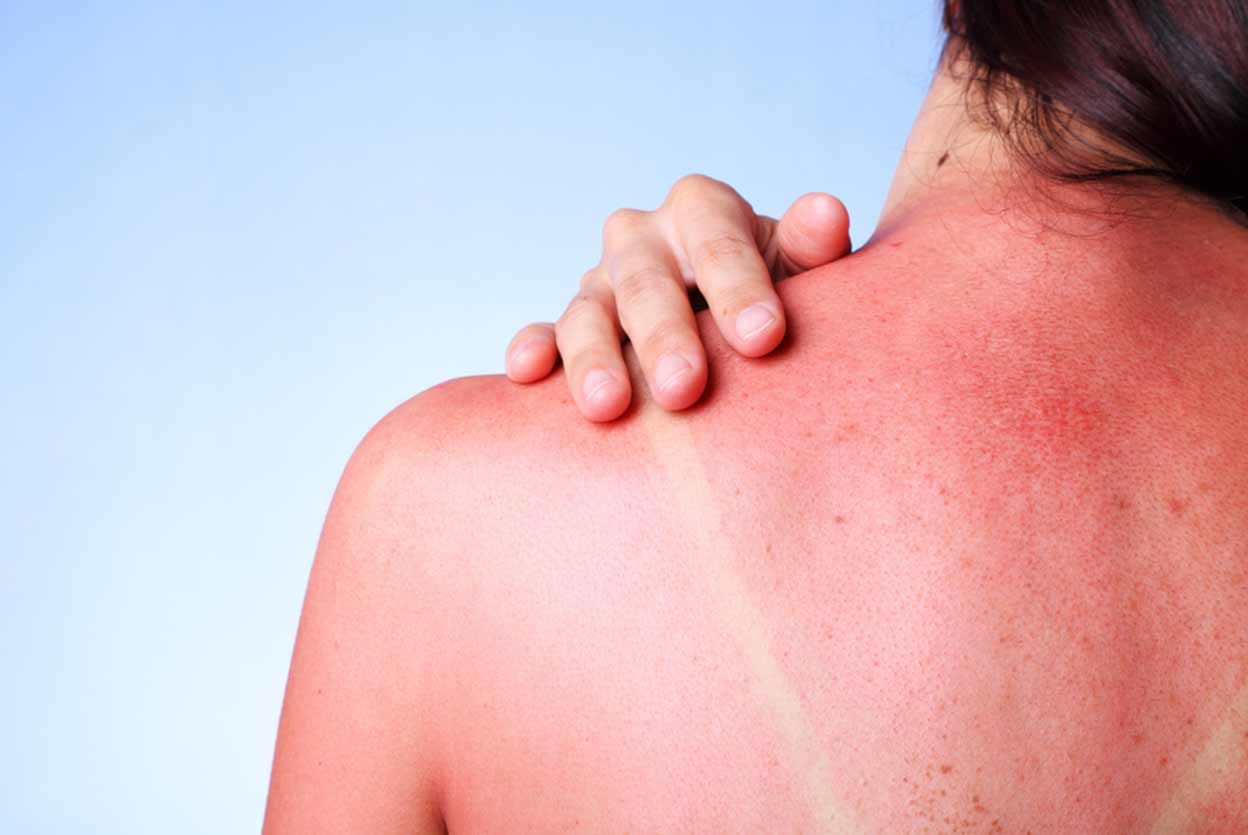7 Skin Problems Caused Due To Sun Exposure!