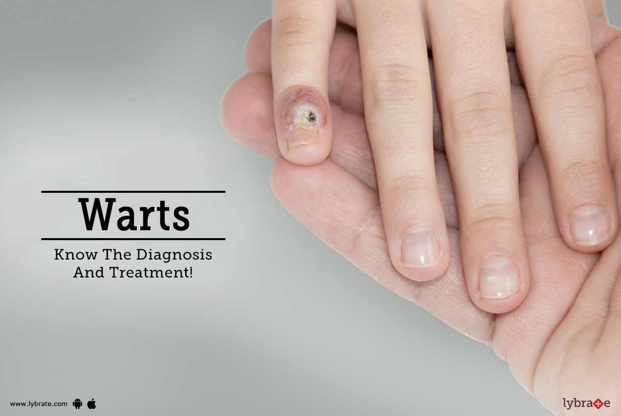 Warts - Know The Diagnosis And Treatment!