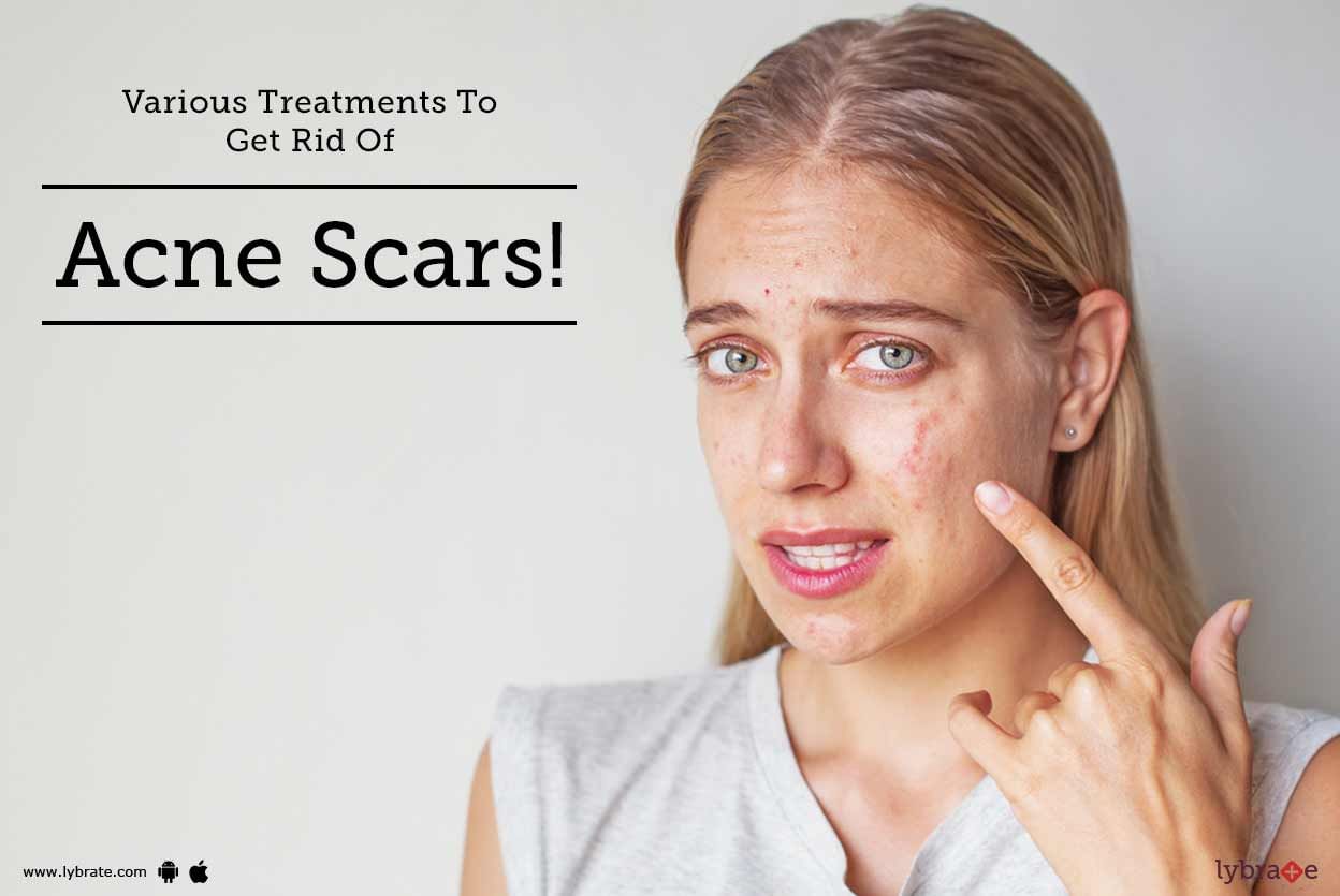 Various Treatments To Get Rid Of Acne Scars!