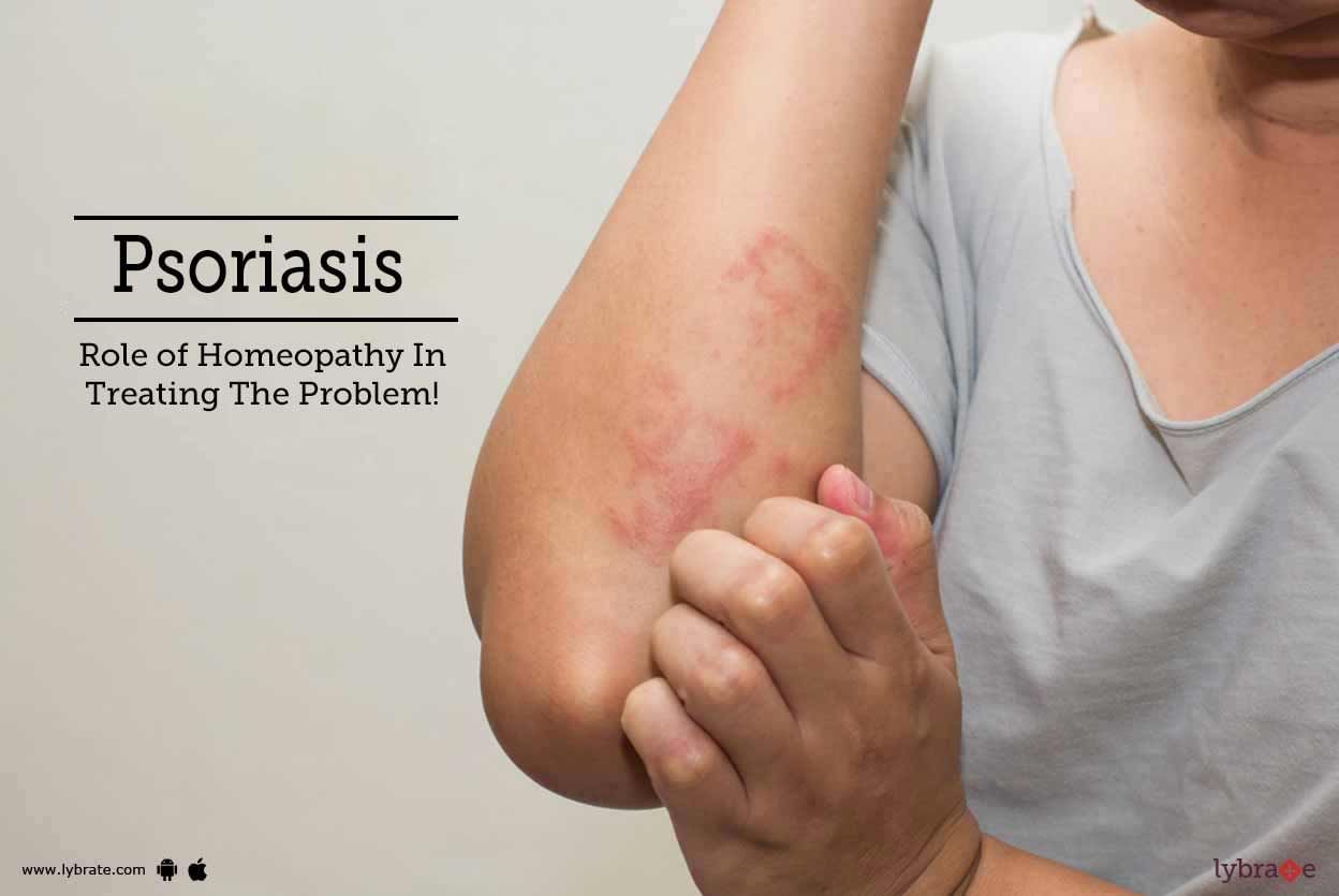 Psoriasis - Role of Homeopathy In Treating The Problem!